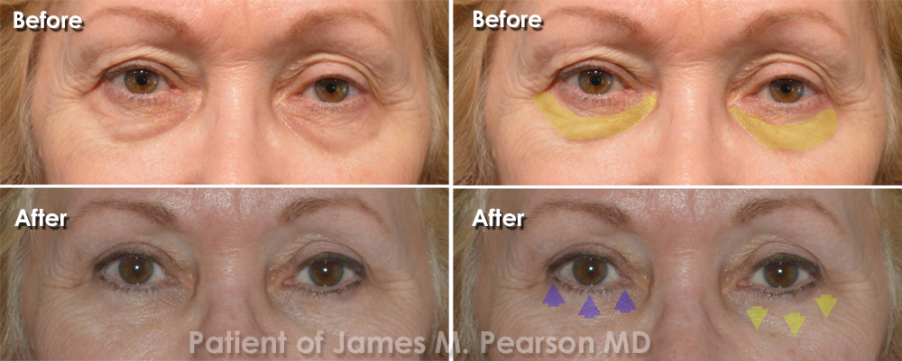 Pearson Cosmetic Eyelid Surgery