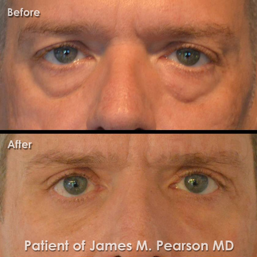 Photo Pearson Eyelid Surgery for Men