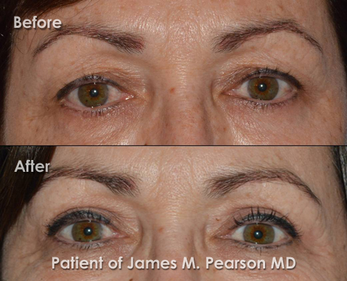 Pearson Eyelid Surgery Photo