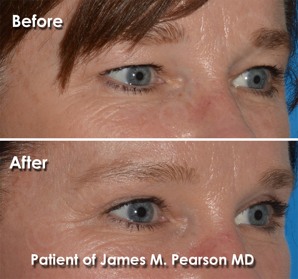 Dr. Pearson Facial Plastic Surgeon