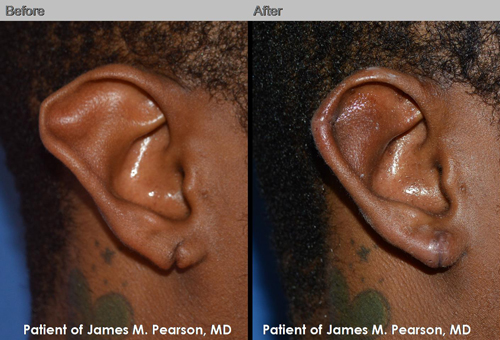 Pearson Ear Plastic Surgery