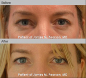 Dr. Pearson Eye Rejuvenation Photos