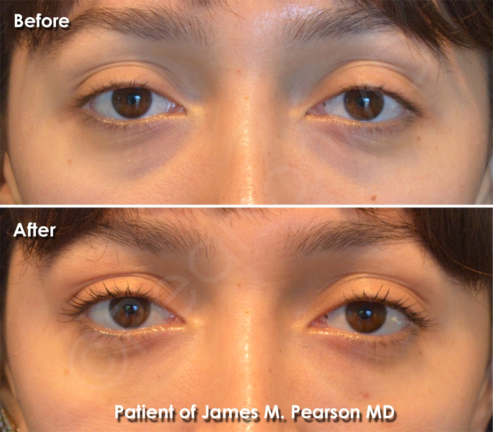Pearson Eye Rejuvenation Photos