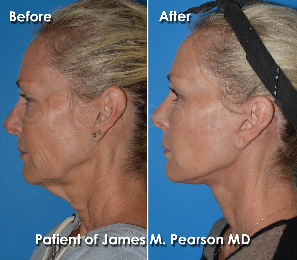 Dr. Pearson Facelift Surgery
