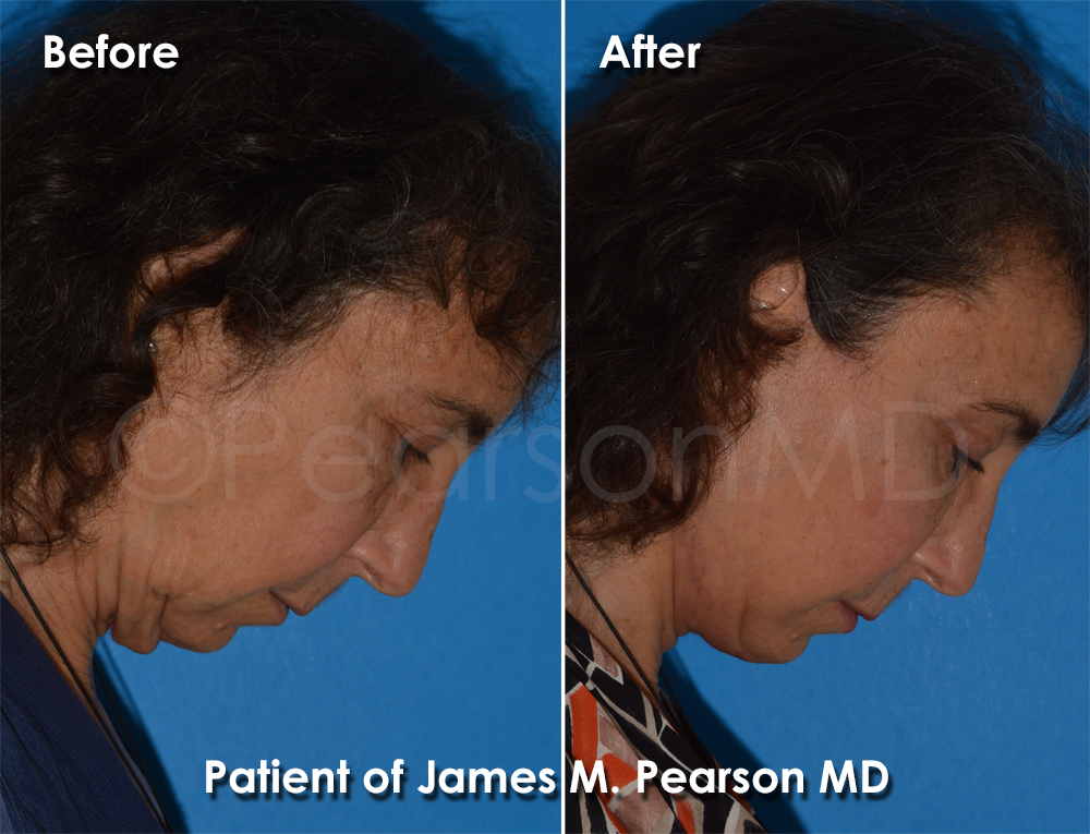 Dr. Pearson Facelift Surgery