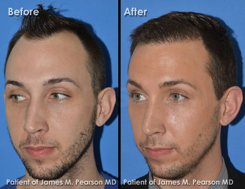 Photo Pearson Hair Restoration
