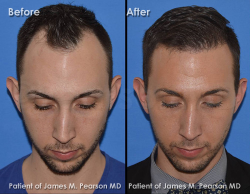 Photo Pearson Hair Restoration
