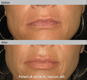 Dr. Pearson Lip Enhancement Photos
