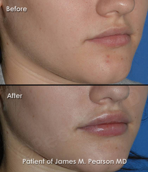 Beverly Hills Lip Implant Photos