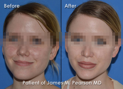Pearson Lip Implant Photos