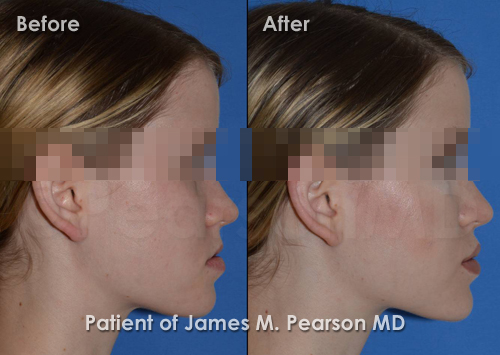 Pearson Lip Implant Photos
