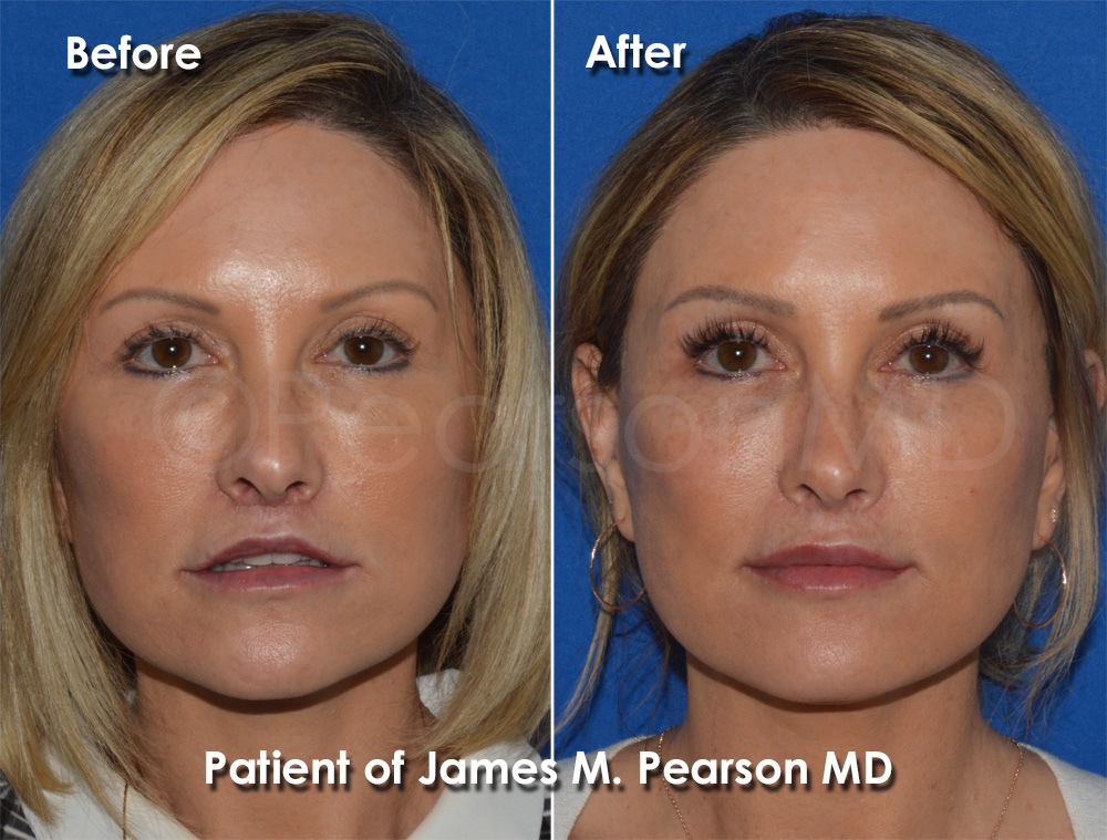 Pearson Plastic Surgery