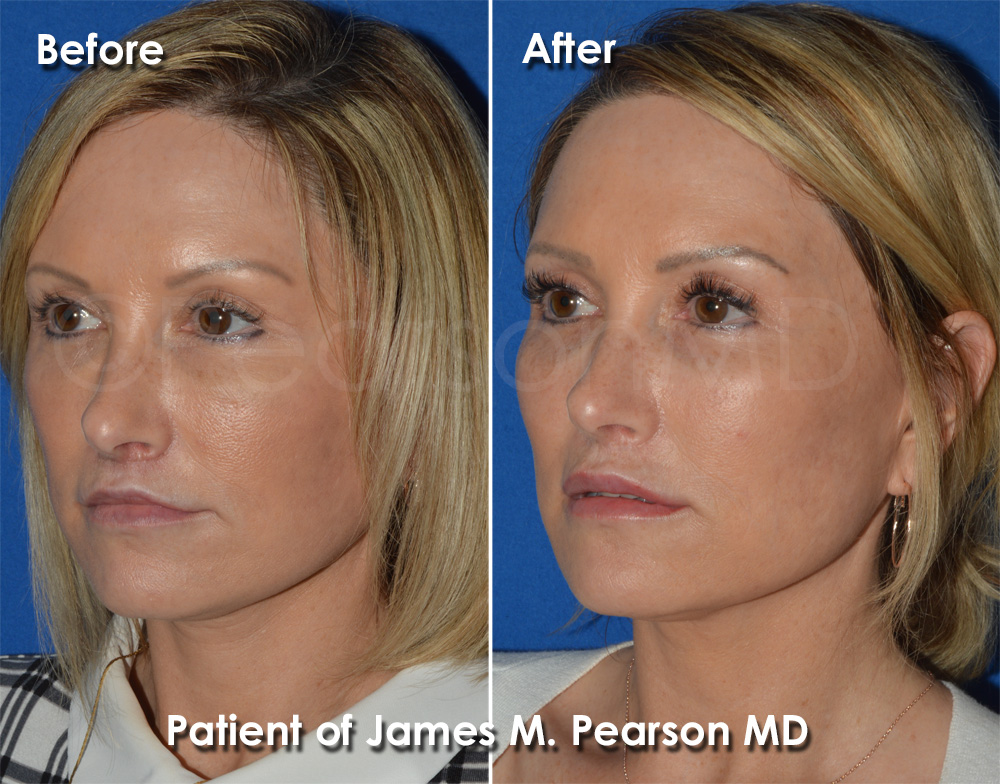 Pearson Facial Surgery