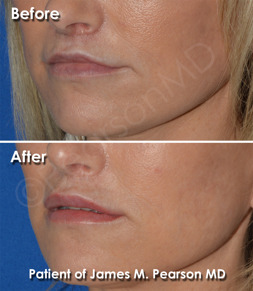 Pearson Facial Surgery