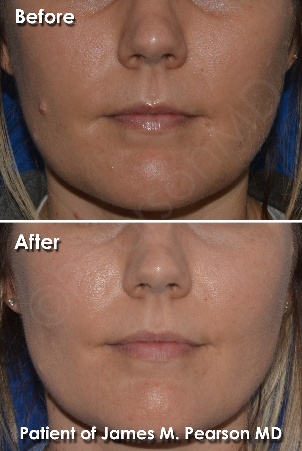 Photo Los Angeles Beverly Hills Mole Removal
