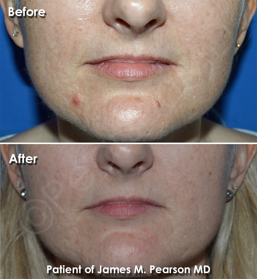 Photo Los Angeles Beverly Hills Mole Removal