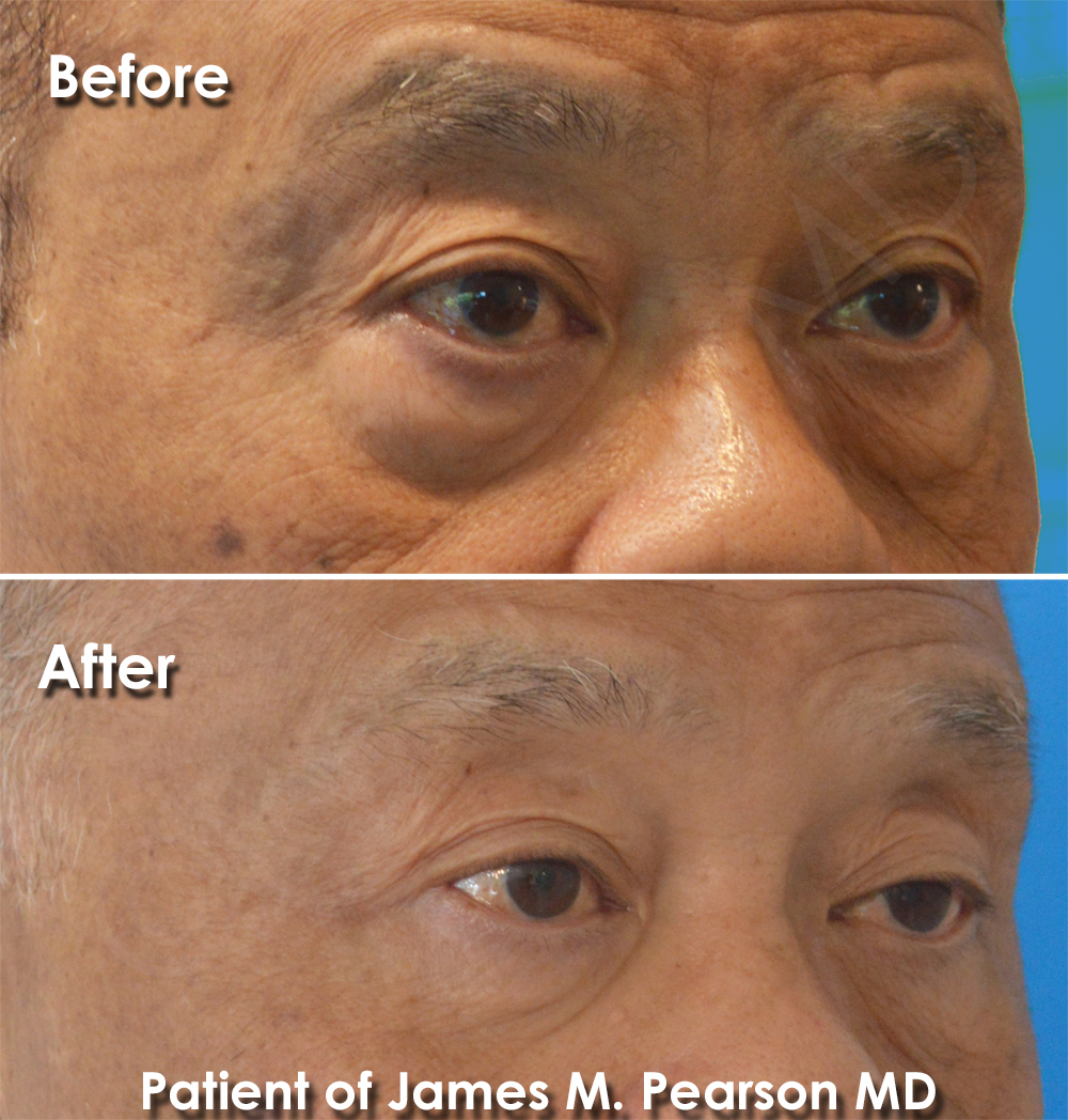 Dr. Pearson Facial Plastic Surgeon