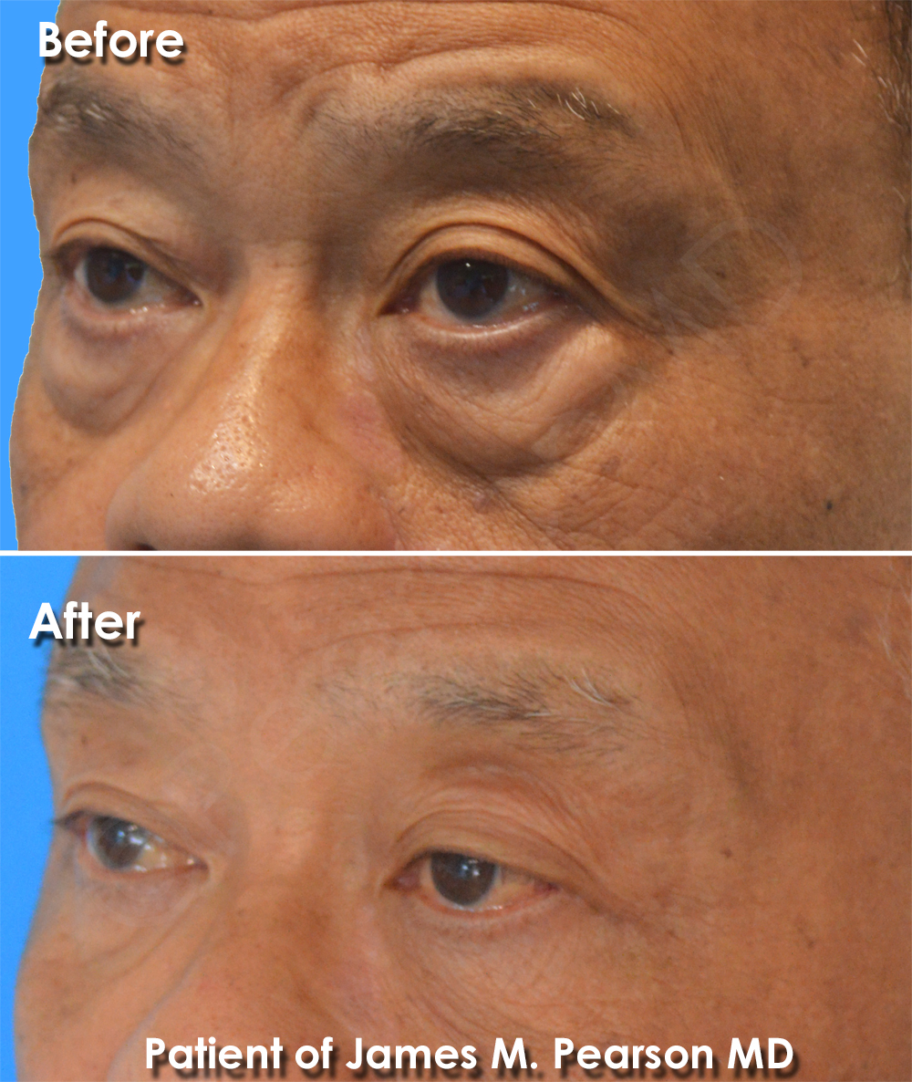 Dr. Pearson Facial Plastic Surgeon