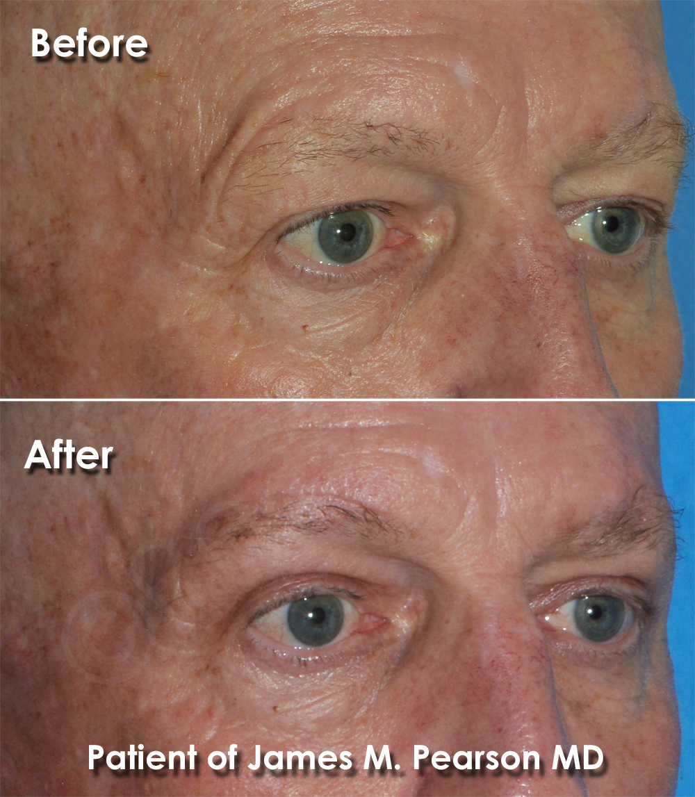 Brow Lift Dr. James Pearson Facial Plastic Surgery