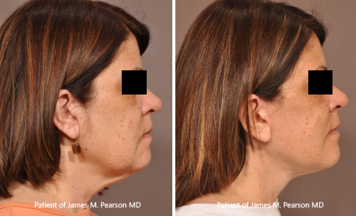 Photos Lower Facelift Dr. Pearson Photos Pearson Facelift