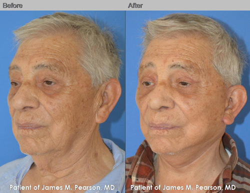 Dr. Pearson Male Facelift Before and After Dr. Pearson Male Facelift & Neck Lift Photo