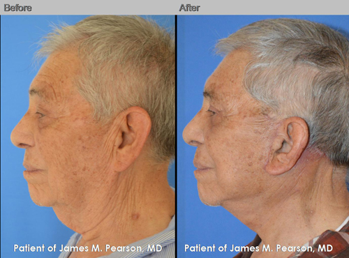Dr. Pearson Male Neck Lift Before and After Dr. Pearson Male Neck Lift Photo