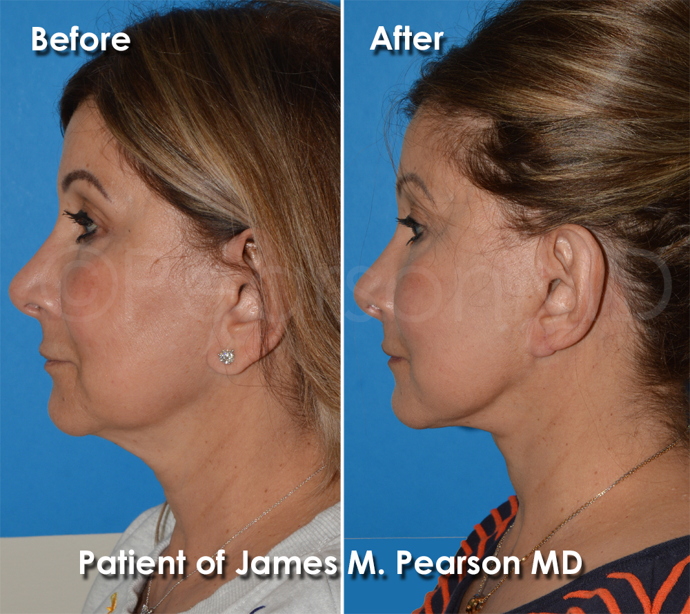 Dr. Pearson Facelift