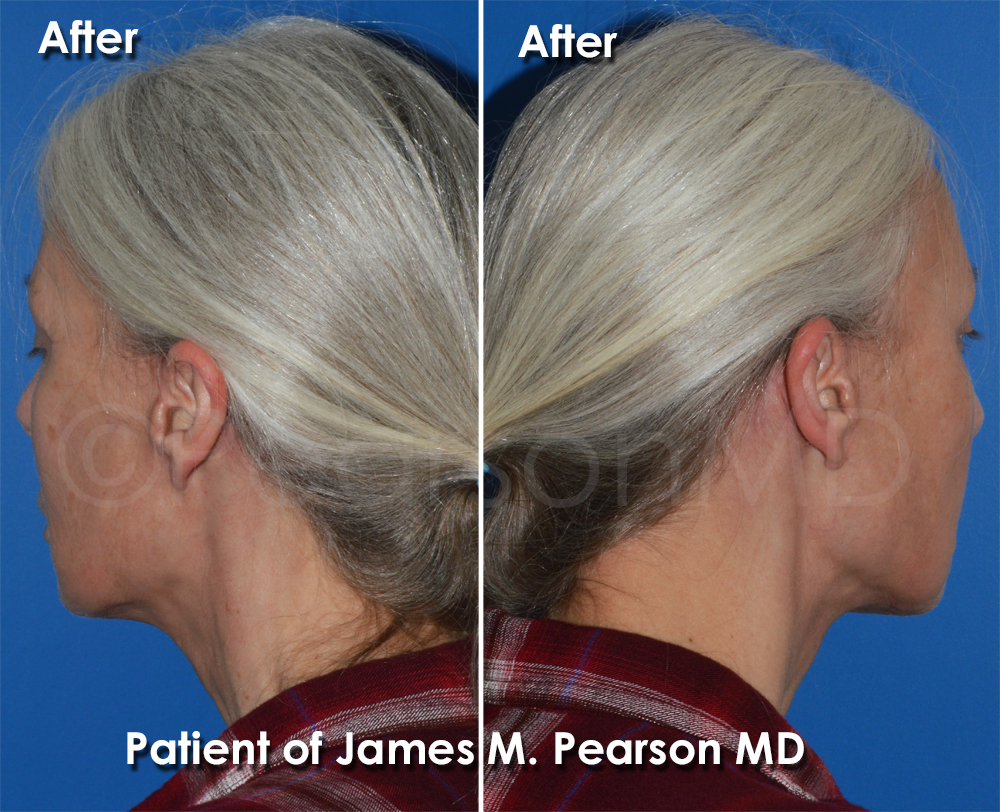 Dr. Pearson Facelift Surgery