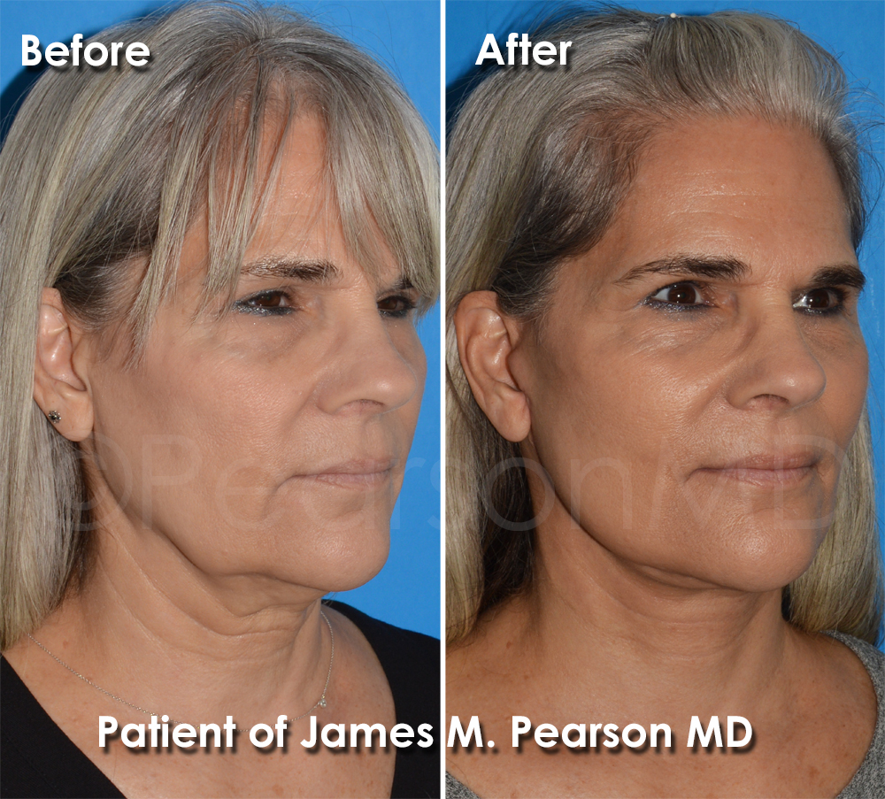 Pearson Plastic Surgery