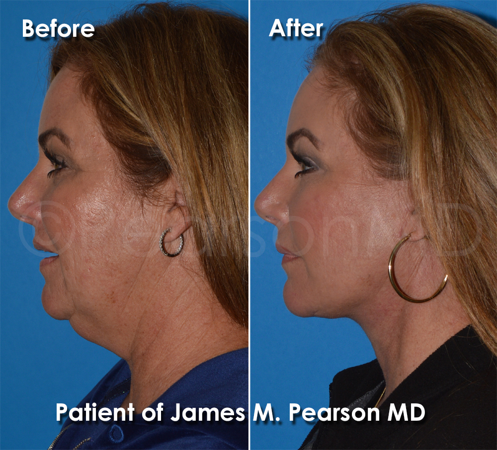 Dr. Pearson Facelift