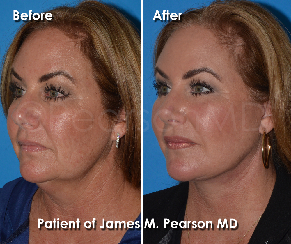 Dr. Pearson Facelift Surgery