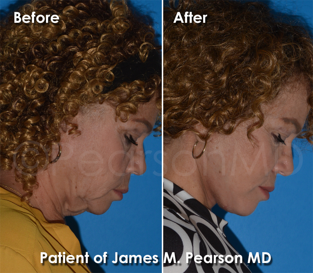 Dr. Pearson Facelift