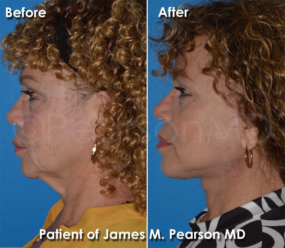Pearson Plastic Surgery