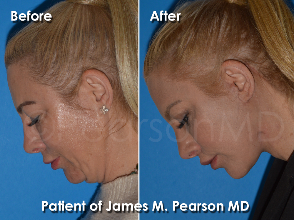 Pearson Plastic Surgery