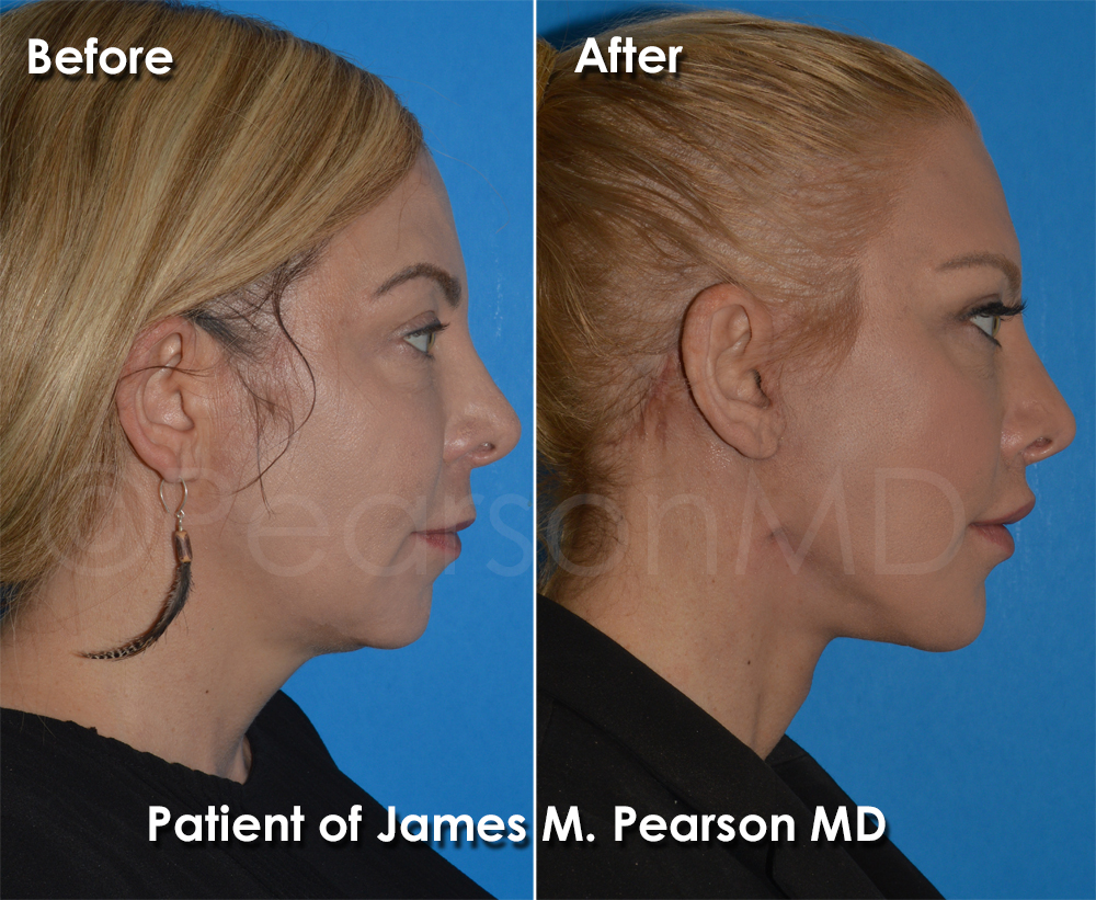 Dr. Pearson Plastic Surgeon