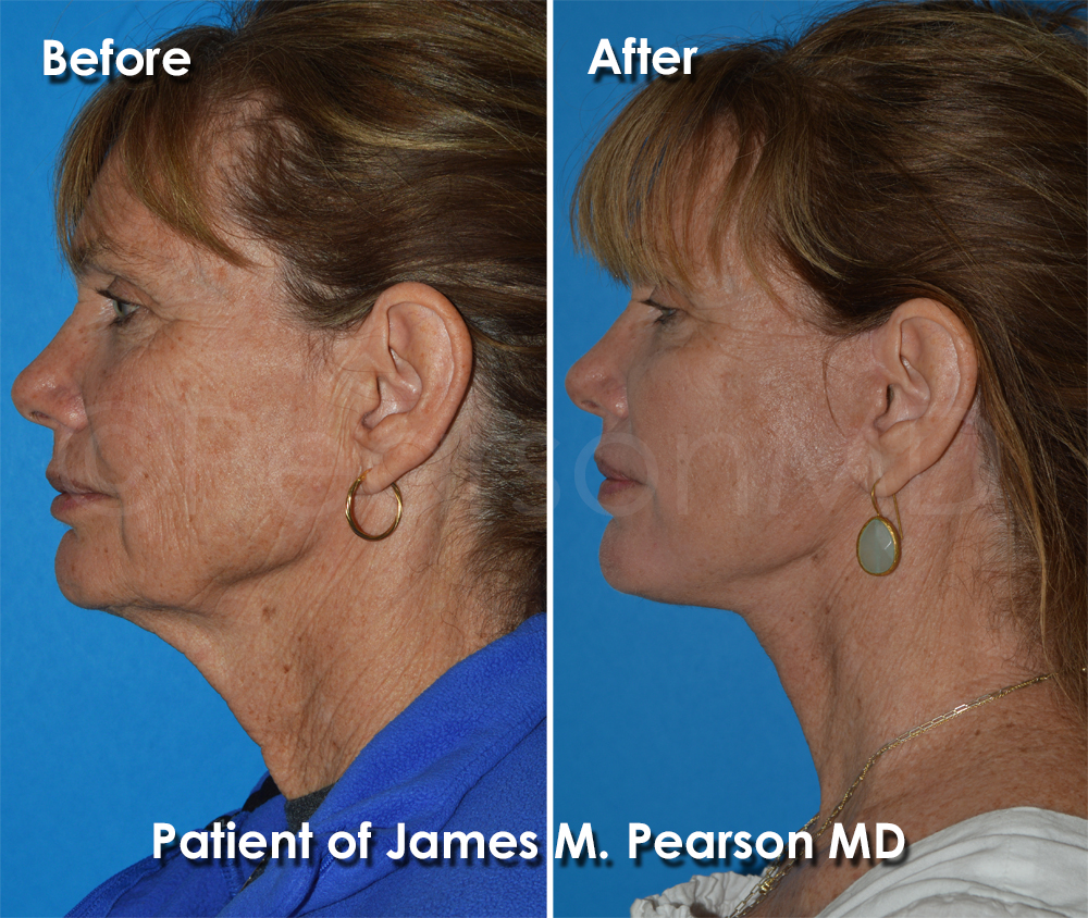Pearson Plastic Surgery