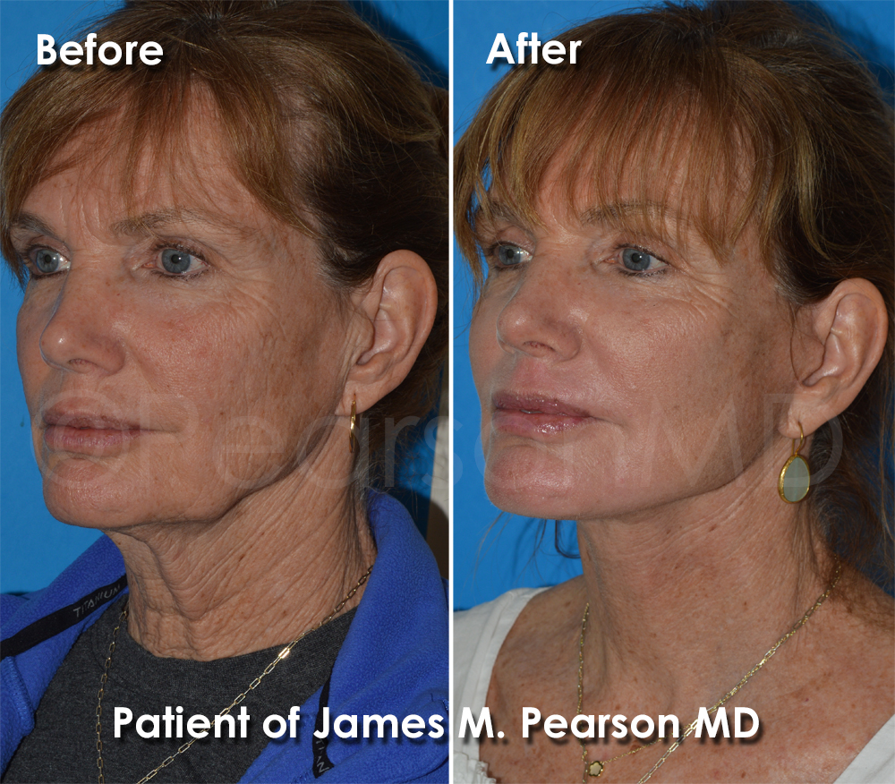 Pearson Plastic Surgery