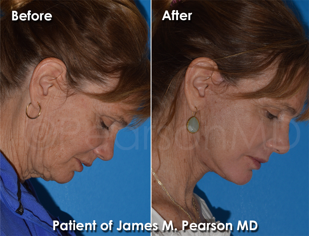 Dr. Pearson Plastic Surgeon