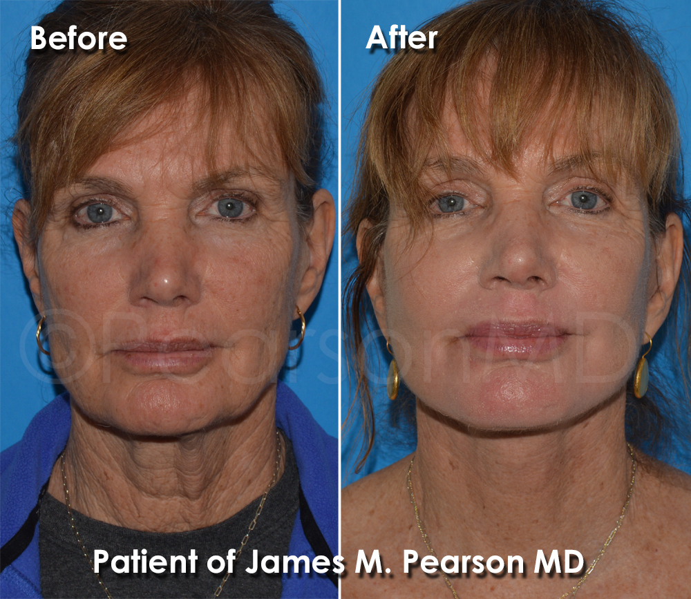 Pearson Plastic Surgery