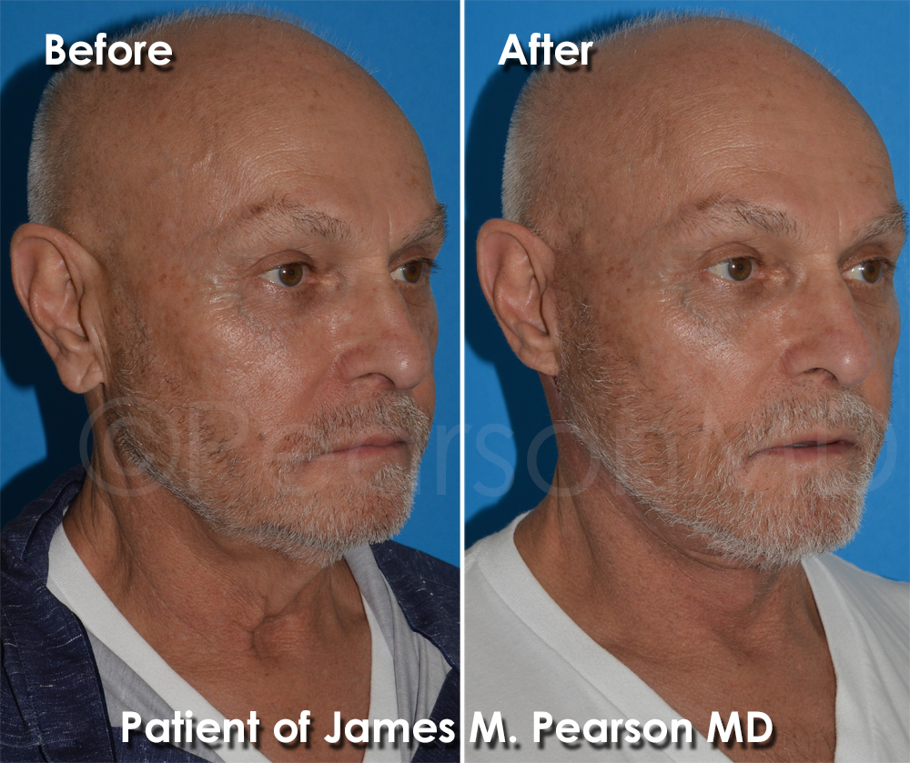 Pearson Plastic Surgery
