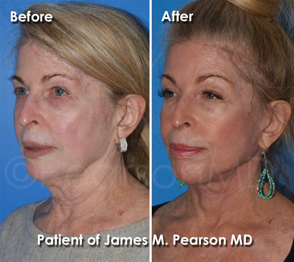 Dr. Pearson Plastic Surgeon