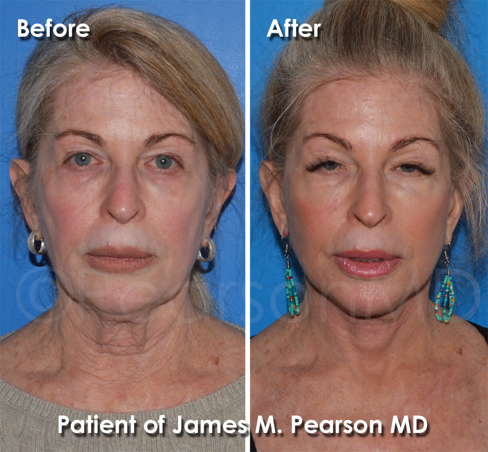 Pearson Plastic Surgery