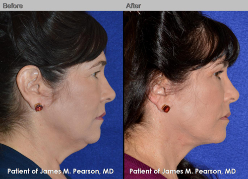 Dr. Pearson Male Neck Lift Before and After Dr. Pearson Male Neck Lift Photo