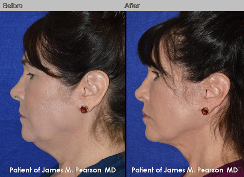Dr. Pearson Male Neck Lift Before and After Dr. Pearson Male Neck Lift Photo