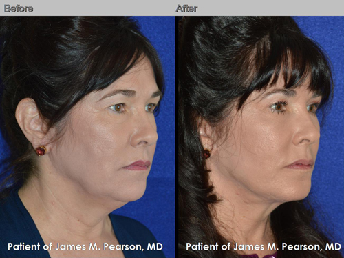 Dr. Pearson Male Neck Lift Before and After Dr. Pearson Male Neck Lift Photo