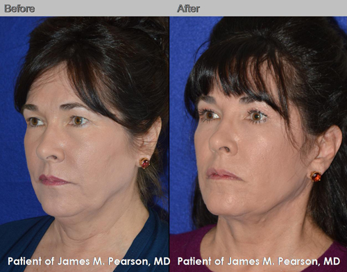 Dr. Pearson Male Neck Lift Before and After Dr. Pearson Male Neck Lift Photo