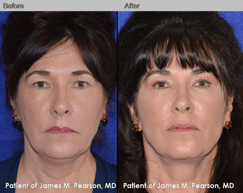 Dr. Pearson Male Neck Lift Before and After Dr. Pearson Male Neck Lift Photo