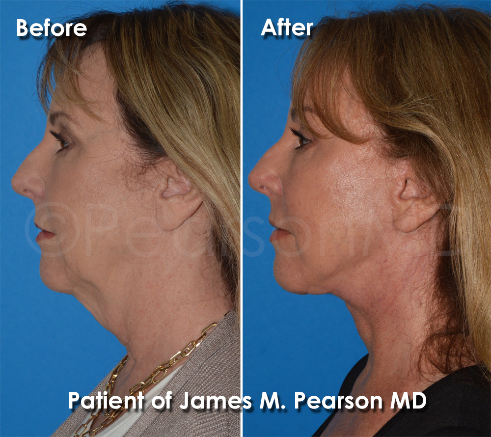 Dr. Pearson Plastic Surgeon