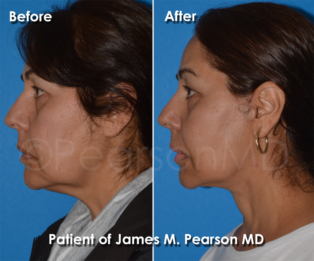 Dr. Pearson Plastic Surgeon