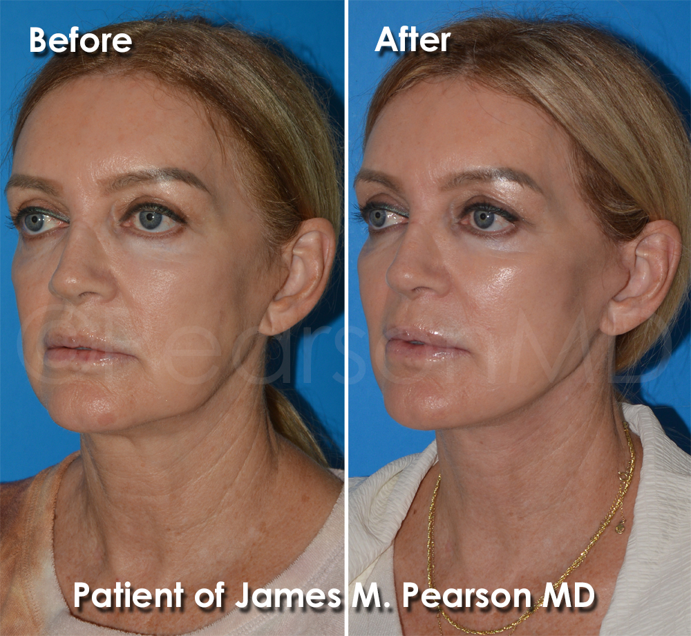 Dr. Pearson Plastic Surgeon